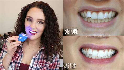 Teeth Whitening at Bright Now! Dental